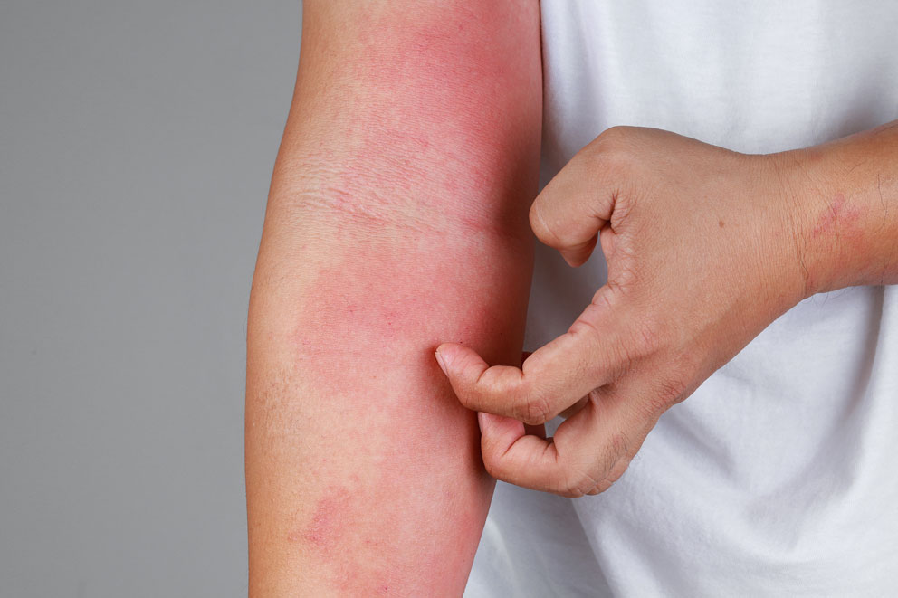 Impara a conoscere la tua dermatite atopica