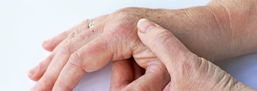 mani con gonfiore da artrite psoriasica
