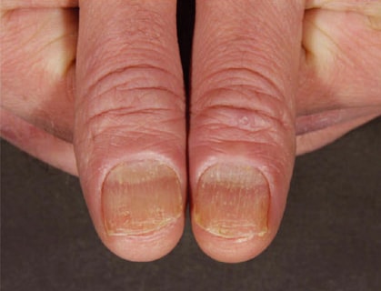 artrite psoriasica unghie