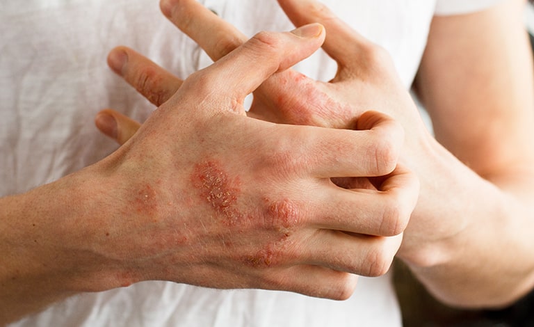 persona con segni di dermatite che si gratta le mani