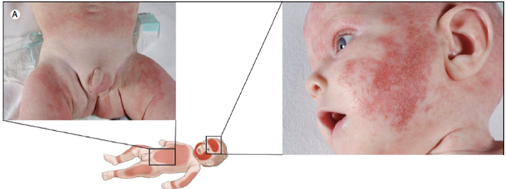 neonato con lesioni da dermatite atopica lesioni sul viso e sulle superfici estensorie degli arti